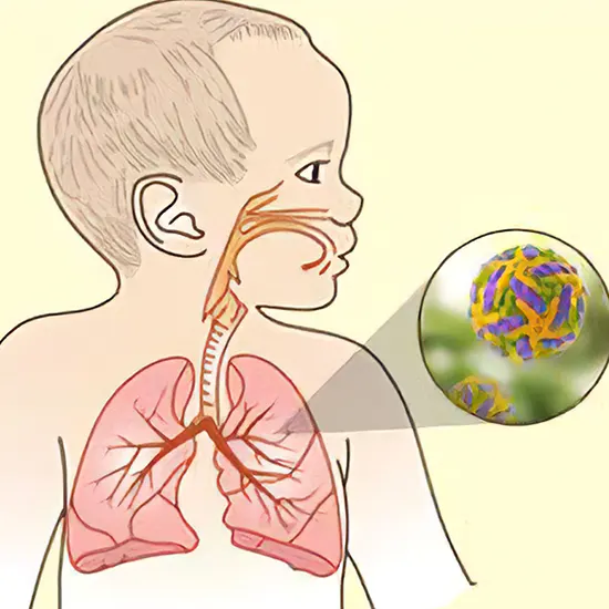 Respiratory Syncytial Virus Infection : Understanding the Causes, Symptoms, and Treatment